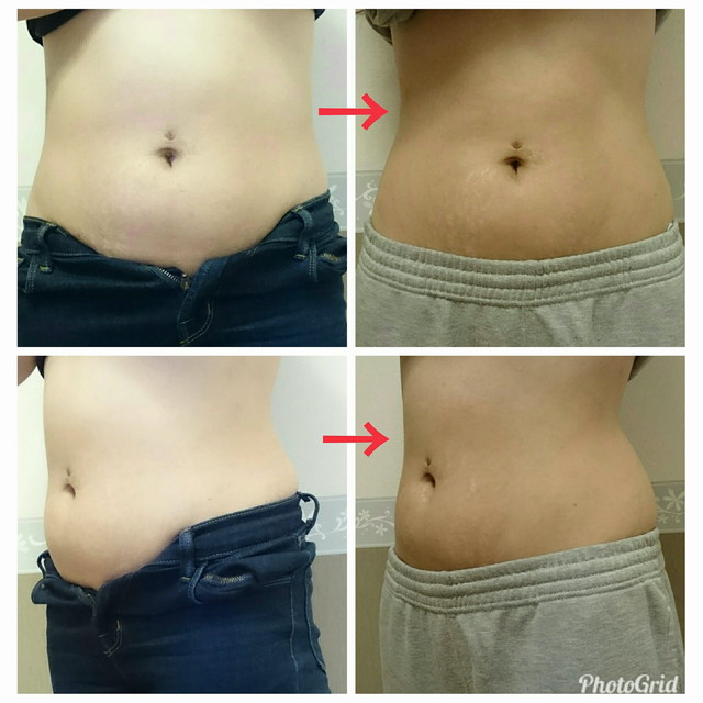 トリートメント２回の変化。前に出ていたお腹の張りが無くなりスッキリしたシルエットに。ウエストもしっか...