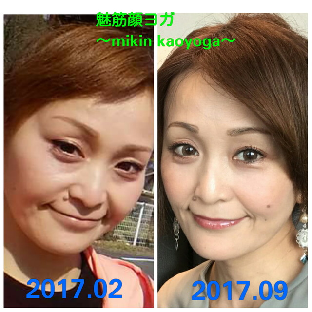 むくみが消えた事で、2回り程小顔になる。顎もシャープになり、体重は2キロ程増加しているのに…顔痩せ効果...