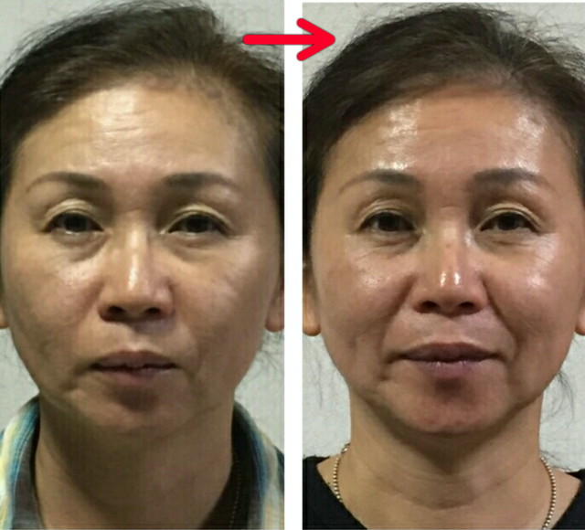 3回集中グループレッスン受講の生徒様(スタートから１ヶ月程での変化)。全体的にリフトアップ!!