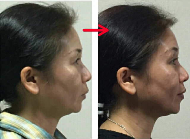 『顔ヨガを始めてからお肌の調子も良くなった』との御本人からのご感想通り、艶の有る美肌に!!