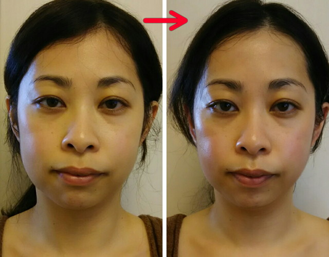 むくみ・たるみがリセットされ、小鼻が小さくスッキリとしたメリハリの有る顔立ちに!!