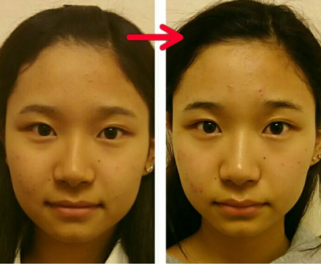 日頃あまり動かさず、眠っていた頬の筋肉や目元の筋肉を目覚めさせる事で全体的な小顔効果と目力upを実現!!...