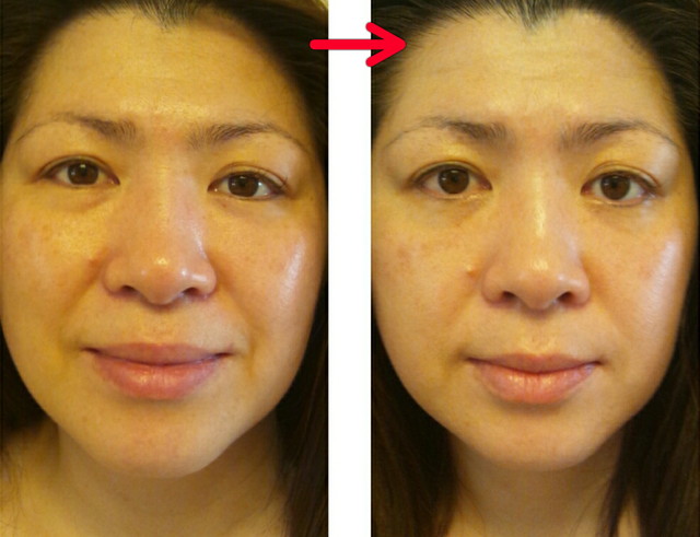 40代前半。全体的に外側にのっぺりと広がり気味だったお顔のパーツが中心の方にキレイに整列!!ほうれい線も...