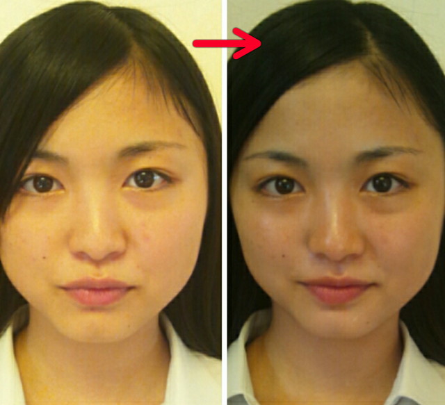 10代後半。浮腫みが取れて更に目鼻立ちがクッキリの美人顔に!!撮影時の光の加減でafterのお写真の方がお肌が暗...