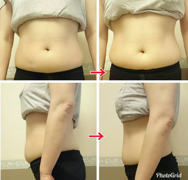 トリートメント１回の変化。前に出ていた胃の部分がスッキリして、ウエストもくびれ、下腹のお肉も少しスッ...