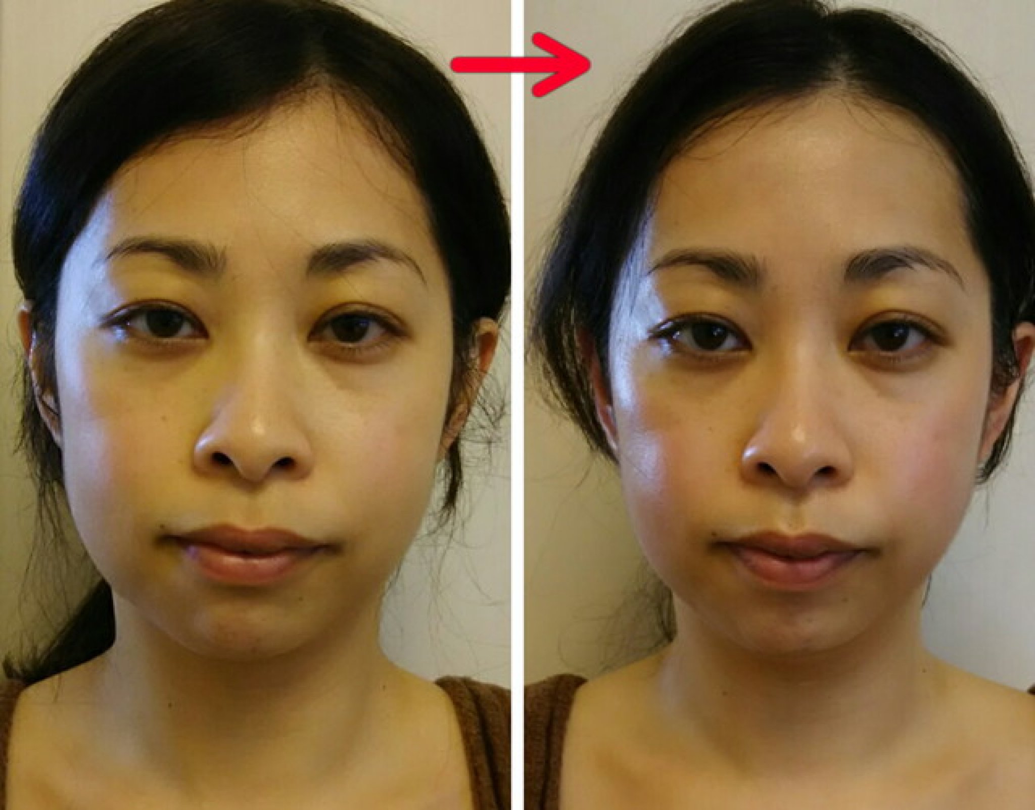 むくみ・たるみがリセットされ、小鼻が小さくスッキリとしたメリハリの有る顔立ちに!!
